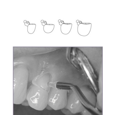 Kervikaalimatriisi LM multiholder refill